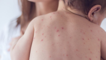 Фотография к новости: ДСМ қызылша ауруының өршу себебін түсіндірді