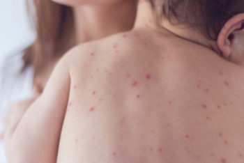 Фотография к новости: ДСМ қызылша ауруының өршу себебін түсіндірді