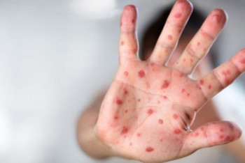 Фотография к новости: Атырау облысында екпе алмаған балалар қызылшаға шалдығып жатыр