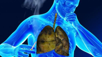 Фотография к новости: Бронхит. Пайда болу себептері мен аурудың алдын алу жолдары