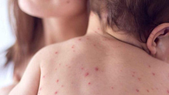 Фотография к новости: Бекшин: Елде қызылшаға шалдығу фактілері төмендеді 