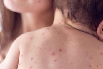 Фотография к новости: Бекшин: Елде қызылшаға шалдығу фактілері төмендеді 