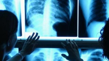 Фотография к новости: Биыл туберкулезді емдеуге 50 млрд теңгеге жуық қаржы бөлінді