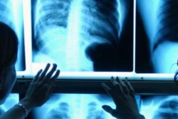 Фотография к новости: Биыл туберкулезді емдеуге 50 млрд теңгеге жуық қаржы бөлінді