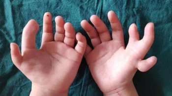 Фотография к новости: Қытайда 14 саусағы бар қызға ота жасалды 