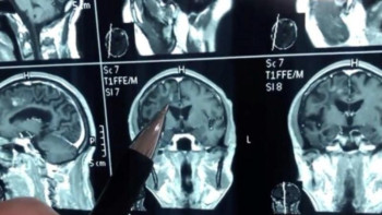 Фотография к новости: Қытай тұрғынының миында 30 жыл бойы құрт болған