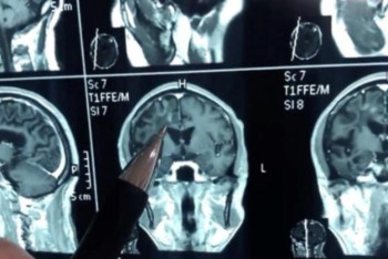 Фотография к новости: Қытай тұрғынының миында 30 жыл бойы құрт болған