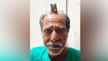 Фотография к новости: Дәрігерлер үндістандықтың 10 сантиметрлік «шайтан мүйізін» қағып алды