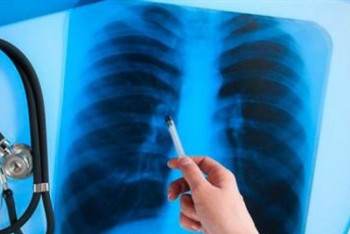 Фотография к новости: Нұр-Сұлтанда «Stop туберкулез!» акциясы басталды