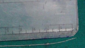 Фотография к новости: Үндістан тұрғынының көзінен 7 см құрт алынды