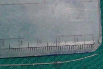 Фотография к новости: Үндістан тұрғынының көзінен 7 см құрт алынды