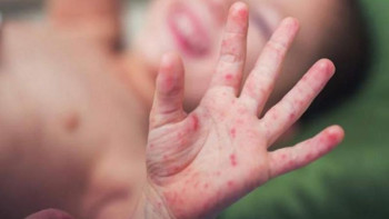 Фотография к новости: Елімізде Кавасаки синдромымен қанша бала ауырып жатыр?