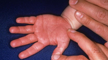 Фотография к новости: Елімізде Кавасаки синдромымен балалардың жаппай ауырып жатқаны рас па?