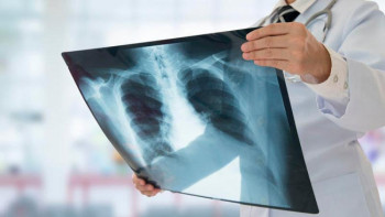 Фотография к новости: Өкпе қабынуынан емделген пациенттер саны неге күрт артты?