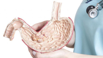 Фотография к новости: Қазақстанда асқазан қатерлі ісігі кең таралған 