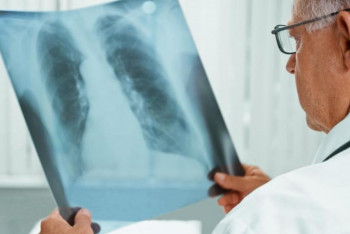 Қазақстанда туберкулезге шалдығу көрсеткіші 21%-ға төмендеді