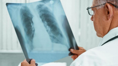 Қазақстанда туберкулезге шалдығу көрсеткіші 21%-ға төмендеді