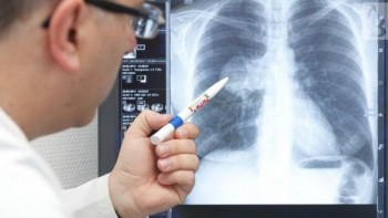 Фотография к новости: Алматыда 1 тамыздан бастап коронавирустық пневмонияға 1 666 науқас шалдыққан