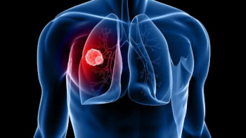 Фотография к новости: Скрининг жүргізілгенде қатысушылардың 50-70%-да ісіктің І сатысы анықталады – шетелдік онколог