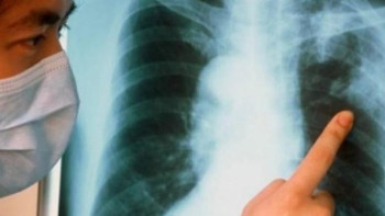 Фотография к новости: Сотталғандар арасында туберкулезді емдеудің жаңа тәжірибесі енгізілді – Шайдуллина