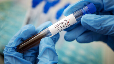 Өткен тәулікте 440 адам  коронавирус жұқтырған