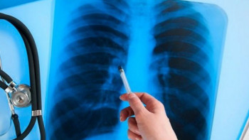 Фотография к новости: Елімізде туберкулезге қарсы айлығы өтеді