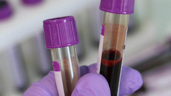 Фотография к новости: Былтыр 450-ден астам елордалық туберкулез жұқтырған - ДСМ