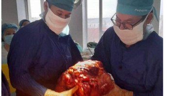 Фотография к новости: Атырауда дәрігерлергер науқастан 15 келілік ісік алды