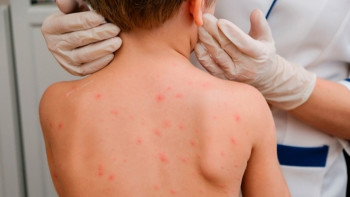 Фотография к новости: Астанада соңғы екі жылда алғаш рет балалар қызылша жұқтырып жатыр - дәрігер