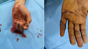 Фотография к новости: Дәрігерлер 9 жасар баланың екіге бөлінген саусағын жалғап берді