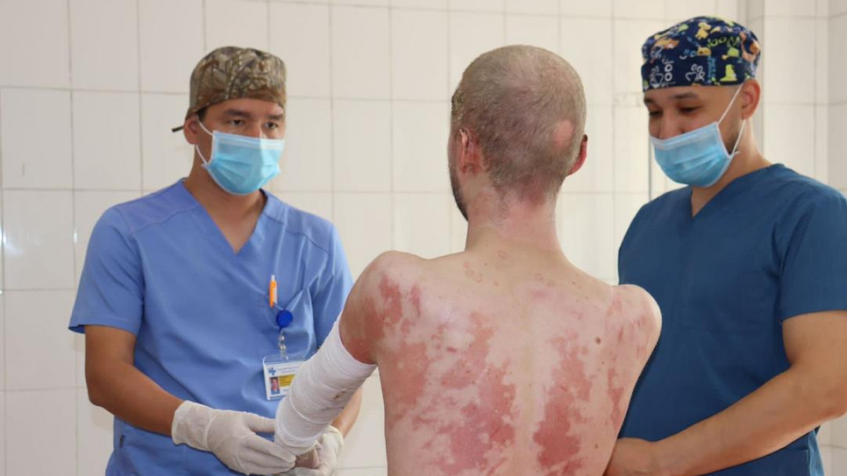 Алматылық дәрігерлер денесін 94% күйік шалған пациенттің өмірін сақтап қалды