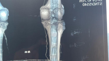 Фотография к новости: Елордалық дәрігерлер үш пациентке өте сирек кездесетін ерекше ота жасады