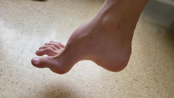 Фотография к новости: Алматыда алғаш рет ат табан балаға ота жасалды