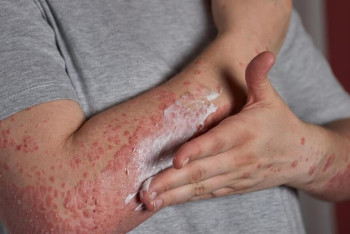 Фотография к новости: Елде псориаз диагнозы қойылған 6242 пациент бар