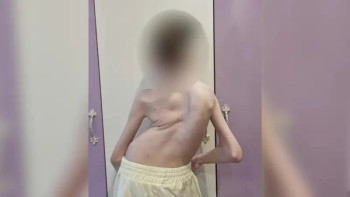 Фотография к новости: Омыртқасы 140 градусқа қисайған балаға күрделі ота жасалды