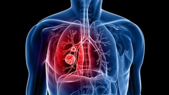 Фотография к новости: Қазақстандықтарды өкпе скринингінен өтуге шақырады