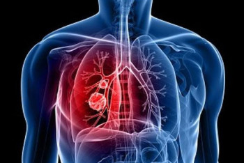 Фотография к новости: Қазақстандықтарды өкпе скринингінен өтуге шақырады