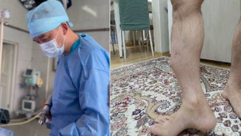 Фотография к новости: Алматылық дәрігерлер 30 жыл аурудың азабын тартқан науқасқа сәтті ота жасады