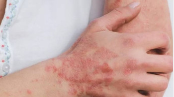 Фотография к новости: Қазақстандықтар псориазды инновациялық емдеуді тегін ала алады