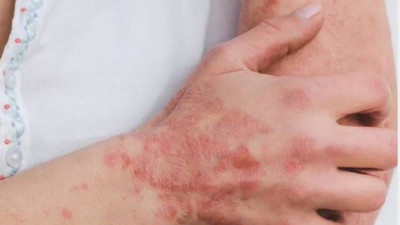 Қазақстандықтар псориазды инновациялық емдеуді тегін ала алады