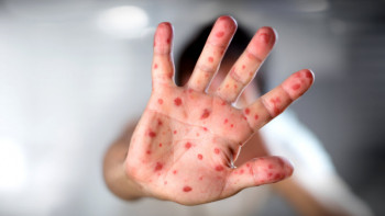 Фотография к новости: Атырау облысында 31 адам қызылша жұқтырған