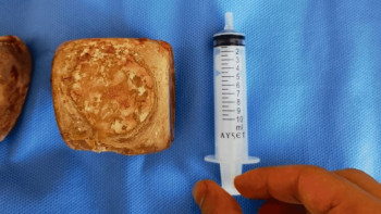 Фотография к новости: Дәрігерлер пациенттің ішінен үлкен пирамидалар тапты