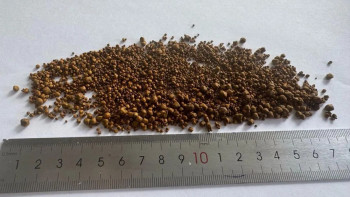 Фотография к новости: Хирургтер науқастың өтінен 5499 тас алып шықты