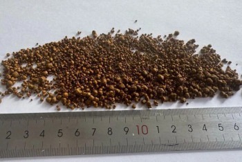 Хирургтер науқастың өтінен 5499 тас алып шықты