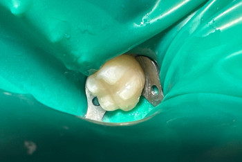 Адам тісі алғаш рет зертханада өсірілді: стоматологияда төңкеріс болуы мүмкін