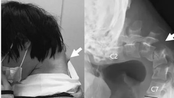 Фотография к новости: Телефонға тәуелділік: Жапонияда басы салбырап қалған жігітке күрделі ота жасалды