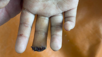 Фотография к новости: Саусағынан айырылған оқушының оқиғасына қатысты тергеу басталды