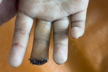 Фотография к новости: Саусағынан айырылған оқушының оқиғасына қатысты тергеу басталды