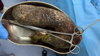 Фотография к новости: 14 жастағы баланың асқазанынан 1,5 келіге жуық шаш шықты