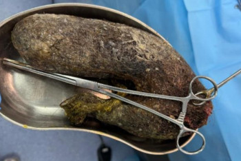 Фотография к новости: 14 жастағы баланың асқазанынан 1,5 келіге жуық шаш шықты